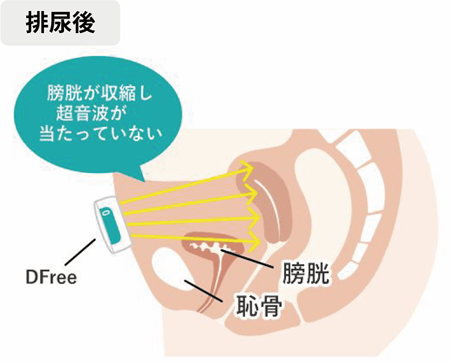 排尿後は膀胱が収縮し超音波が当たっていない