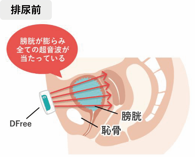 排尿前は膀胱が膨らみ全ての超音波が当たっている