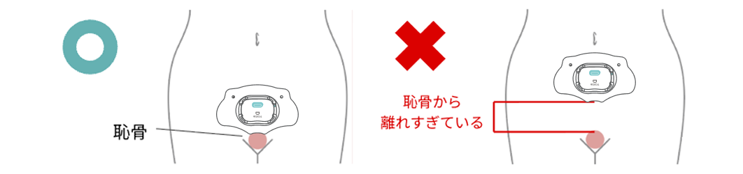 ○：恥骨の上側に装着用シートのくぼみがくるように装着します。✗：恥骨から離れすぎている。