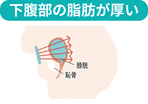 下腹部の脂肪が厚いときの状態